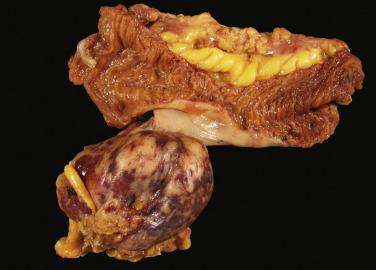 FIG. 9.6, Gastrointestinal stromal tumor of the jejunum. The tumor extends from the serosa with a pedunculated appearance.