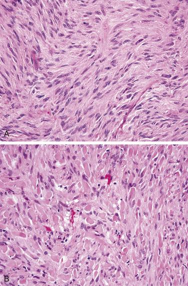 FIG. 9.7, Gastrointestinal stromal tumor, spindle cell type. (A) The tumor consists of fascicles of bland spindle cells with abundant fibrillary cytoplasm. (B) Skeinoid fibers are typical of such tumors at this site.