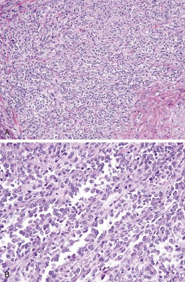 FIG. 9.9, Clear cell sarcoma-like tumor of the small intestine composed of sheets and vague nests of uniform rounded cells with small amounts of variably clear cytoplasm (A). A focally alveolar growth pattern is commonly observed (B). Note the indistinct nucleoli and scant cytoplasm.
