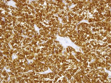 FIG. 9.10, Strong immunoreactivity for S-100 protein is typical of gastrointestinal clear cell sarcoma-like tumor. Melanocytic markers are usually negative (not shown).