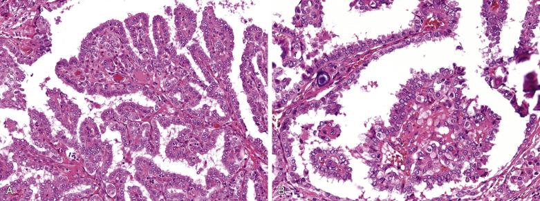 FIG. 18A.12, Papillary carcinoma. (A) Most arborizing papillae have delicate fibrovascular cores, while occasional broader ones have follicles in the cores (left upper field). (B) Papillae project into cystic spaces. Laminated psammoma bodies are seen in the cores of the papillae. Note the pale-staining nuclei of the tumor cells.