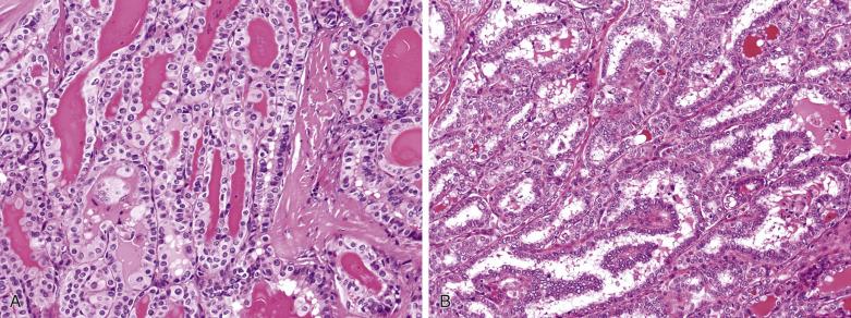 FIG. 18A.13, Papillary carcinoma. (A) Follicles are frequently present. They are usually elongated and filled with dark-staining colloid. (B) A complex tubulopapillary pattern is common.