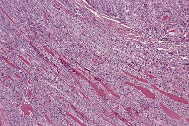 FIG. 18A.14, Papillary carcinoma composed of remarkably elongated follicles and trabeculae.