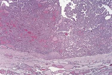 FIG. 18A.16, Encapsulated variant of papillary carcinoma. This tumor is composed of both papillae and follicles.