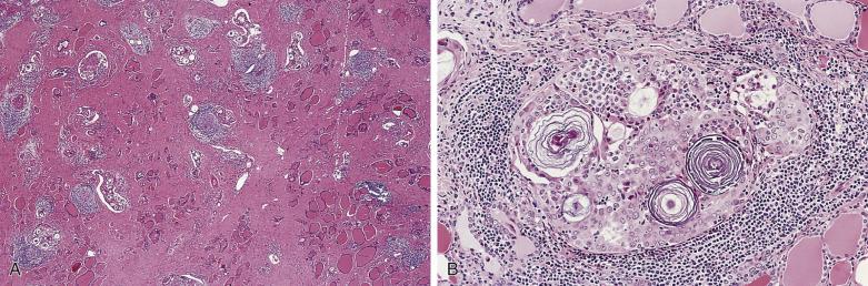 FIG. 18A.18, Diffuse sclerosing variant of papillary carcinoma. (A) The thyroid shows diffuse and extensive fibrosis, lymphoid infiltration, and multiple small islands of tumor, imparting an impression of thyroiditis. (B) The tumor cells often appear squamoid. Psammoma bodies are typically abundant.