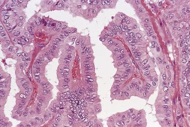 FIG. 18A.20, Tall cell variant of papillary carcinoma. The cells are columnar and possess eosinophilic granular cytoplasm, but the nuclei are no different from those of classic papillary carcinoma.