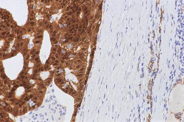 FIG. 18A.27, Papillary carcinoma, cribriform-morular variant. Immunostaining for β-catenin reveals aberrant nuclear localization of the signal. This contrasts with the membranous staining for β-catenin in the normal thyroid follicular epithelium (right field).