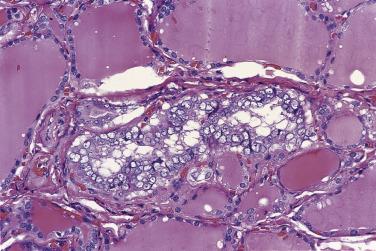 FIG. 18A.32, Incidental papillary carcinoma. This incidentally discovered focus of papillary carcinoma comprises only a few follicles, with no sclerosis. Note the crowded and empty-looking nuclei, which differ significantly from those of the surrounding normal follicles.