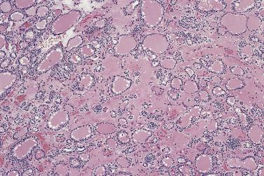 FIG. 18A.40, Metastatic follicular carcinoma in bone. This can be practically indistinguishable from normal thyroid.