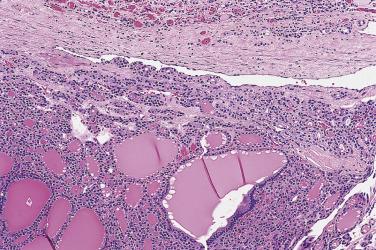 FIG. 18A.43, Follicular adenoma. The mere bulging of the neoplastic follicles of the main tumor toward the inner aspect of the capsular vessels does not constitute an adequate criterion for vascular invasion.