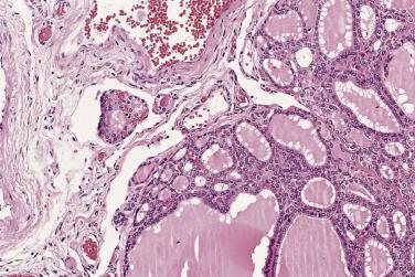 FIG. 18A.44, Pseudovascular invasion in follicular adenoma. The small island in the left field is surrounded by a retracted space. Neither this island nor the space is lined by endothelium.