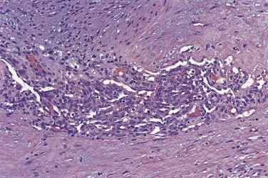 FIG. 18A.46, Follicular neoplasm with capsular intravascular endothelial hyperplasia, mimicking vascular invasion. There is intravascular proliferation of blood vessels, producing irregular clefts.