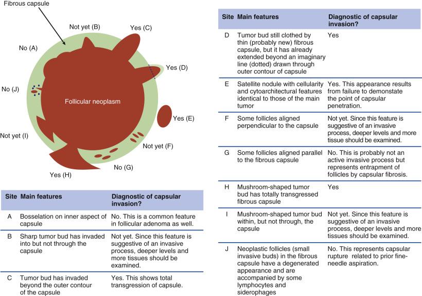 FIG. 18A.48, Schematic drawing to illustrate interpretation of presence or absence of capsular invasion in a follicular neoplasm. The diagram depicts a follicular neoplasm (red) surrounded by a fibrous capsule (green), and the various scenarios.