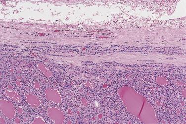 FIG. 18A.49, Follicular adenoma. The presence of compressed follicles aligned parallel to the collagen fibers in the capsule do not count for capsular invasion.