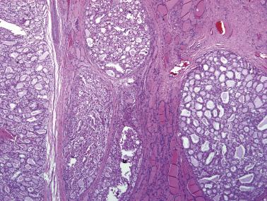 FIG. 18A.52, Widely invasive follicular carcinoma. Multiple nodules of carcinoma with similar cytoarchitectural features (closely packed follicles) infiltrate the thyroid parenchyma.