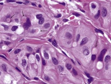 FIG. 18A.54, Hyalinizing trabecular adenoma. Yellow bodies (arrows) are seen in some cells—they are located adjacent to the nucleus and surrounded by a clear halo.