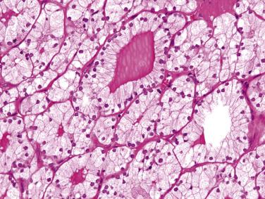 FIG. 18A.57, Follicular adenoma, clear cell variant. The cytoplasm is not water clear, but it exhibits a fine reticular quality.