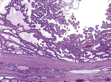 FIG. 18A.58, Follicular adenoma with papillary hyperplasia. (A) The encapsulated tumor comprises complex papillae. (B) The low columnar cells that cover the papillae have regular, basally situated, dark-staining, round nuclei.