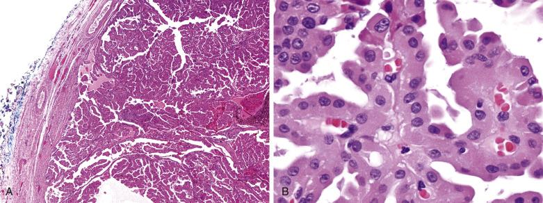 FIG. 18A.59, Encapsulated papillary oncocytic neoplasm. (A) The tumor comprises arborizing papillae and is surrounded by a fibrous capsule. (B) The cells covering the papillae have oncocytic cytoplasm.