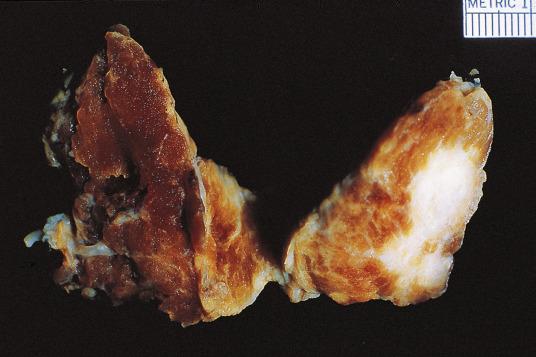 FIG. 18A.6, Gross specimen of papillary carcinoma, featuring solid tumor with ill-defined borders and sclerosis, typical of this tumor type.