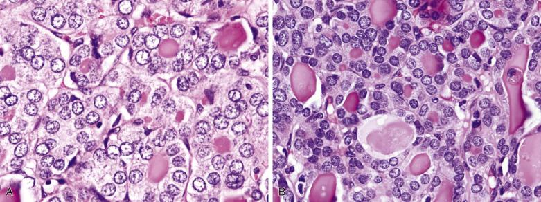 FIG. 18A.66, Follicular adenoma with large pale nuclei. (A) In the central zone, the follicles are lined by cells with large and pale-staining nuclei. These nuclei are not oval and do not show grooving as characteristic of papillary carcinoma. (B) In the peripheral zone, the nuclei are smaller and more hyperchromatic. The findings suggest that the pale nuclei in the central zone result from blowing up of the nuclei due to delayed fixation.