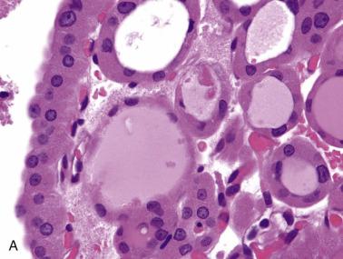 FIG. 18A.68, Hurthle cell adenoma. (A) The follicles are lined by cells with abundant eosinophilic granular cytoplasm. The nuclei are round and show distinct nucleoli. (B) Not uncommonly, scattered tumor cells show oval grooved nuclei or nuclear pseudoinclusion, mimicking the nuclear features of papillary carcinoma. (C) Focal papillary formations are present. (D) The commonly found calcified colloid may be mistaken for psammoma bodies.