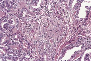 FIG. 18A.10, Squamous metaplasia in papillary carcinoma. Note the bland nuclear morphology in the squamous component.