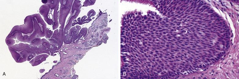 FIG. 4A.1, Sinonasal papilloma, exophytic (septal) type. (A) The tumor has an exophytic and papillary growth protruding from the surface respiratory epithelium and composed of a thickened nonkeratinized squamous (epidermoid) epithelium; note the presence of minor salivary glands in the submucosa indicative of mucosal rather than cutaneous origin. (B) At higher magnification the epithelium is cytomorphologically bland with uniform cells, retention of cellular polarity, absence of cytologic atypia, presence of scattered mucous cysts, and intraepithelial inflammatory cells; residual nonneoplastic ciliated respiratory epithelium is seen along the surface.