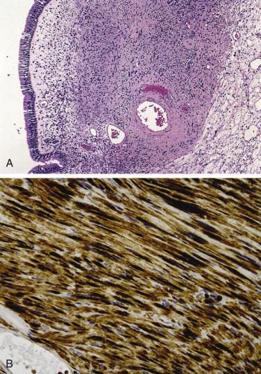 FIG. 4A.11, Sinonasal benign peripheral nerve sheath tumor (benign schwannoma). (A) The tumor is submucosal, encapsulated, and composed of a bland spindle-shaped cellular proliferation with wavy or buckled appearing nuclei, admixed inflammatory cells, and perivascular hyalinization. (B) Diffuse and intense S100-protein immunoreactivity is present.