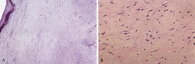 FIG. 4A.12, Sinonasal myxoma. (A) Submucosal loose cellular proliferation with compressed but identifiable vascularity. (B) The cells are spindle shaped or stellate appearing with uniform small, hyperchromatic nuclei embedded; copious mucinous stroma.