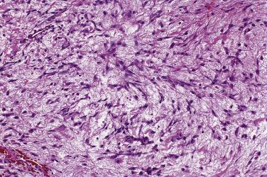 FIG. 4A.13, Sinonasal fibromyxoma. As compared to myxomas the stromal component includes greater collagenous fibrillary material. Cellularity may be increased but still lacks pleomorphism, mitotic figures, and necrosis. The absence of specific immunoreactivity excludes other diagnoses and is required to make the diagnosis of fibromyxoma.