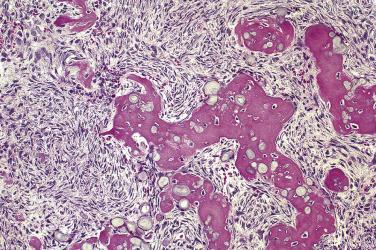 FIG. 4A.15, Aggressive psammomatoid ossifying fibroma. This variant of ossifying fibroma is composed of bony spicules and numerous spherules admixed with a fibrous stroma. The most distinctive component is the presence of mineralized or calcified psammomatoid bodies or ossicles.