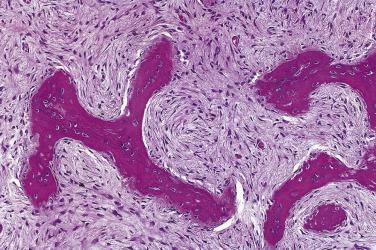 FIG. 4A.16, Sinonasal fibrous dysplasia includes irregularly shaped immature (woven) bone, typically lacking osteoblastic rimming, with an associated nondescript fibrous tissue component.