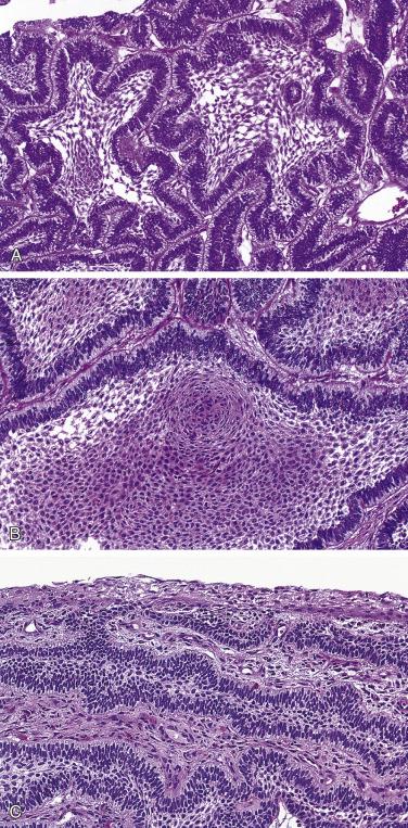 FIG. 4A.17, Sinonasal ameloblastoma. (A) The tumor was unencapsulated and is composed of proliferating nests or islands of odontogenic epithelium, including central area of loosely arranged cells similar to the stellate reticulum of the enamel organ and a peripheral area of palisading columnar or cuboidal cells with hyperchromatic small nuclei oriented away from the basement membrane (reverse polarity). (B) Acanthomatous changes can be seen, as a focal finding or a dominant finding in any given tumor. (C) Ameloblastomatous proliferation is arising in direct continuity with the intact sinonasal surface mucosal epithelium. This finding in the face of an isolated sinonasal mass without continuity with gnathic sites supports the histogenesis of these sinonasal tumors from totipotential cells of the sinonasal mucosal epithelium.