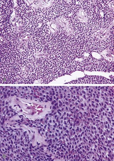 FIG. 4A.18, Sinonasal glomangiopericytoma. (A) The tumor characteristically is submucosal without involvement of the surface epithelium and is cellular, diffuse in its growth, and well vascularized. The neoplastic cells are tightly packed with hyperchromatic nuclei and are situated in and around endothelial-lined vascular spaces; the latter appear dilated and irregularly shaped but there is no intercommunication of the vascular channels. (B) A characteristic finding relative to the vascular spaces is the presence of perivascular (peritheliomatous) hyalinization that in conjunction with the cytomorphology assists in recognizing this tumor.