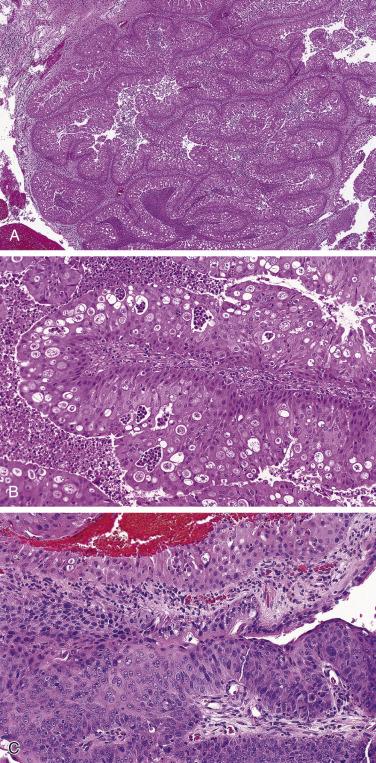 FIG. 4A.3, Sinonasal papilloma, oncocytic type. (A) Exophytic epithelial proliferation with readily apparent eosinophilic appearance. (B) At higher magnification the epithelium is multilayered composed of columnar cells with abundant eosinophilic and granular cytoplasm; intraepithelial mucin cysts, some with polymorphonuclear leukocytes, are present. (C) Malignant transformation of an oncocytic type papilloma showing residual benign epithelium (top) with areas of carcinoma in situ (lower) . Invasive keratinizing squamous cell carcinoma was present in this case (not shown) .