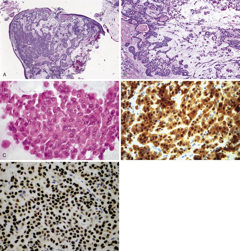 FIG. 4A.4, Intranasal myoepithelial-predominant pleomorphic adenoma. (A) Submucosal unencapsulated cellular proliferation with associated chondromyxoid stroma. (B) Admixture of glands, chondromyxoid stroma, and prominent plasmacytoid myoepithelial cells; the presence of the ductular structure glands and chondromyxoid stroma allow categorization as a pleomorphic adenoma, myoepithelial predominant, and not as a myoepithelioma, which is better regarded as a monomorphic adenoma. (C) At higher magnification details of the plasmacytoid (hyaline cell) myoepithelial cells are better seen; in addition to cytokeratin staining, myoepithelial cells are immunoreactive for (D) S100 protein (nuclear and cytoplasmic) and (E) p63 (nuclear staining). Calponin, another myoepithelial specific marker, will also be positive (not shown) .