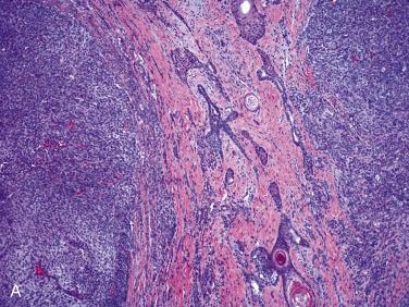 FIG. 4A.5, Salivary gland anlage tumor (SGAT). (A) At low magnification, SGAT is characterized by multiple submucosal solid nodules separated by less cellular stroma and network of delicate linear and branching small ductlike structures and nests of solid or cystic squamous epithelium with variable fibromyxoid stroma. (B) Ductlike structures within cellular stromal nodule composed of round to oval to spindle-shaped nuclei with dispersed nuclear chromatin and eosinophilic cytoplasm with indistinct cell borders.