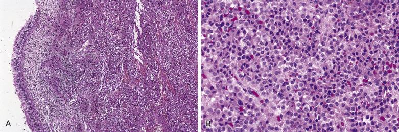 FIG. 4A.6, Ectopic (sphenoid sinus) pituitary adenoma. (A) The neoplastic infiltrate is submucosal and is composed of an epithelioid neoplastic proliferation with an organoid growth pattern. (B) The epithelioid cells have round nuclei with dispersed chromatin pattern and granular eosinophilic cytoplasm. Immunohistochemical stains confirmed a pituitary neoplasm.