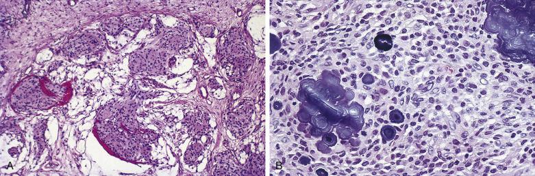 FIG. 4A.7, Sinonasal tract (ectopic) meningioma. (A) This submucosal situated cellular proliferation shows a lobular growth pattern with tumor nests separated by a variable amount of fibroconnective tissue and with a whorled arrangement. (B) The neoplastic cells have round to oval nuclei with pale-staining cytoplasm, indistinct cell borders, and characteristic punched-out or empty appearance resulting from intranuclear cytoplasmic inclusions; several psammoma bodies are present.