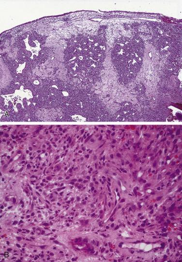 FIG. 4A.8, Sinonasal lobular capillary hemangioma. (A) Submucosal lobular proliferation in which variable sized vascular spaces are present, including some with irregular to staghorn shapes. (B) Surrounding the endothelial-lined irregularly shaped vascular space is a mixed cellular infiltrate, including inflammatory cells and fibroblasts. This combination of findings is diagnostic for lobular capillary hemangioma and contrasts to the diffuse growth pattern and monomorphic cellular proliferation seen in sinonasal glomangiopericytoma.