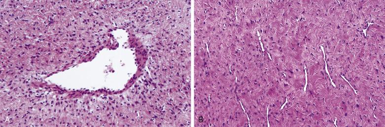 FIG. 4A.9, (Nasopharyngeal) angiofibroma. These tumors are composed of a variable admixture of fibrocollagenous stroma with associated spindle- to stellate-shaped cells and variably sized vascular spaces. The vascular component includes thin-walled structures varying in appearance from (A) readily apparent to (B) less conspicuous due to marked compression from the collagenized stroma. Note that the vascular walls have an incomplete or absent smooth muscle layer. The spindle-shaped cells are immunoreactive for (C) nuclear β-catenin and (D) androgen receptor (nuclear).