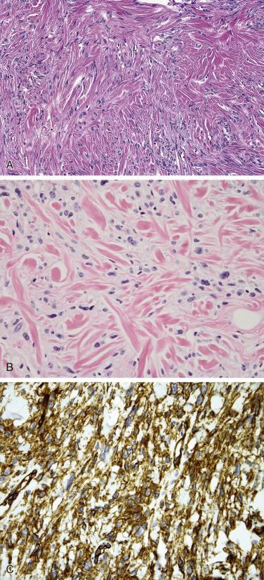 FIG. 4A.10, Solitary fibrous tumor of the sinonasal tract. (A) This tumor was unencapsulated and is composed of a variably cellular proliferation of bland spindle-shaped cells lacking any pattern of growth with associated ropey collagen or (B) keloidal collagen bundles; cells are immunoreactive for (C) CD34 and (D) STAT6 (nuclear staining).