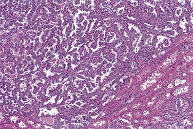 FIG. 12A.1, Papillary adenoma composed of complex papillae covered by small cells.