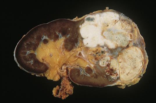 FIG. 12A.11, Clear cell renal cell carcinoma. In this tumor, the white areas were histologically sarcomatoid.