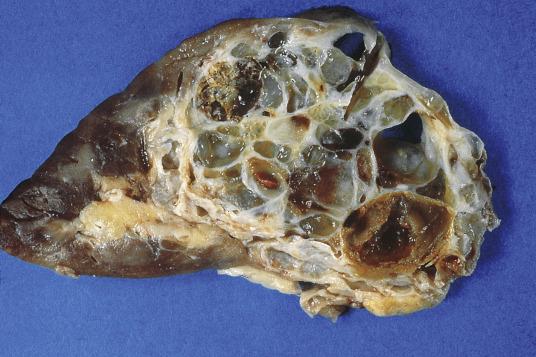 FIG. 12A.12, Multilocular cystic renal cell neoplasm of low malignant potential. Numerous thin-walled locules of variable size make up this tumor.