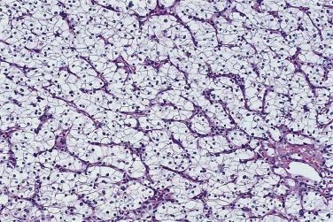 FIG. 12A.13, Clear cell renal cell carcinoma. The prominent delicate vasculature surrounding alveolar clusters of cells is typical of clear cell renal cell carcinoma.