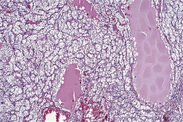 FIG. 12A.14, Clear cell renal cell carcinoma. Tubules and small cysts filled with eosinophilic proteinaceous fluid or fresh hemorrhage are typical of clear cell renal cell carcinoma.