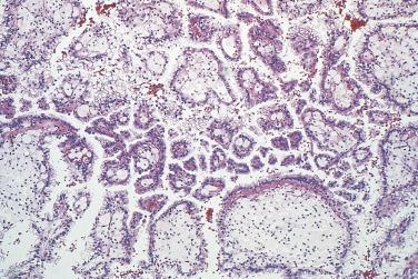 FIG. 12A.15, Papillary renal cell carcinoma. The stromal cores of the papillae are distended by collections of foamy histiocytes.