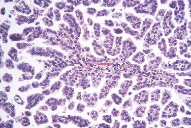 FIG. 12A.16, Papillary renal cell carcinoma. Small cells with inconspicuous pale cytoplasm cover the papillae of type 1 papillary renal cell carcinoma.